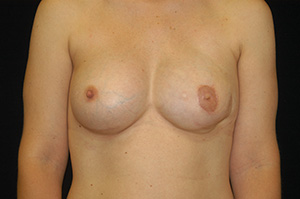 Breast Reconstruction 1b
